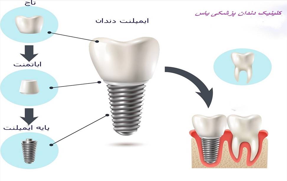 جراحی ایمپلنت