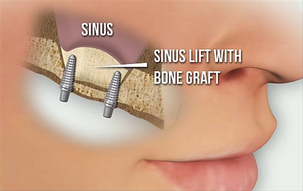 جراحی Sinus Lift 